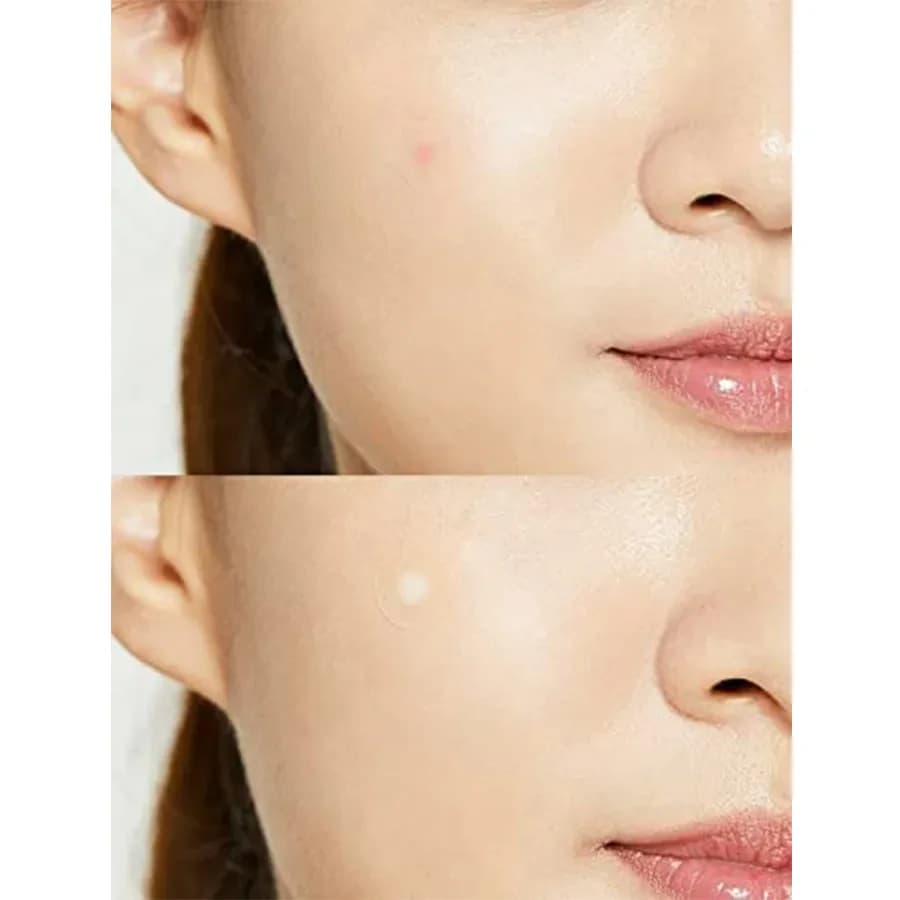EyeNlip BEAUTY AC Clear Spot Patch 24 Patches 3